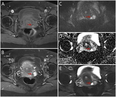 Case report: Superficial cervicovaginal myofibroblastoma of the cervix with endometrial carcinoma
